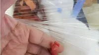 Terlahir Seberat 400 Gram, Bayi Mungil Ini Mampu Bertahan Hidup