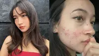Jerawat jadi salah satu momok menakutkan bagi perempuan, termasuk aktris Megan Domani. [Instagram @megandomani1410]