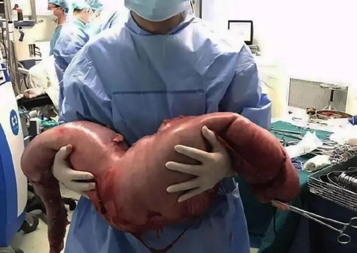 Dokter mengeluarkan kotoran dari usus besar pria China. (Shanghai Tenth People Hospital)