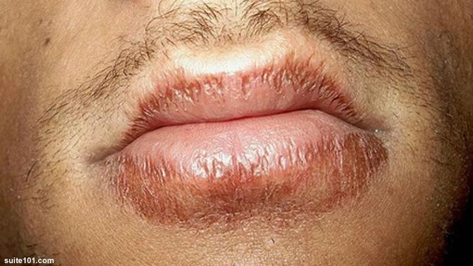Di Sekitar Bibir Anda Berwarna Gelap Coba Cara Ini Health Liputan6 Com