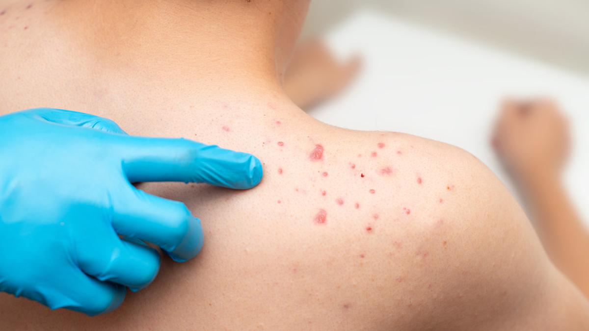 Jerawat Punggung Tak Kunjung Hilang? Coba Pilih Sabun Mandi dengan Formula Ini