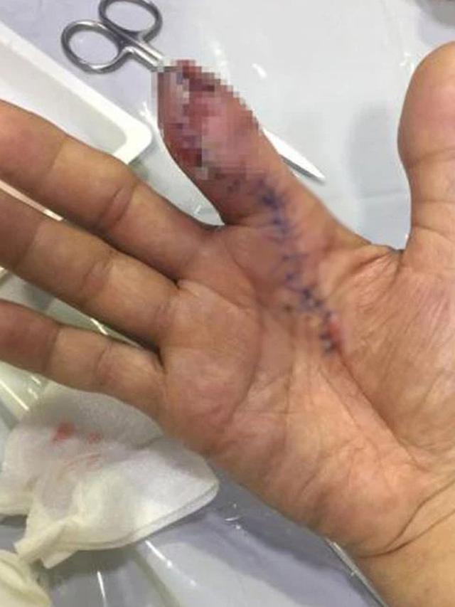 Luka Tertusuk Udang Mentah Terinfeksi Bakteri Pemakan Daging, Pria Ini Kehilangan Jarinya