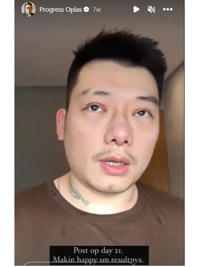 7 Potret Chef William Gozali Jalani Operasi Plastik, Perubahannya Bikin Pangling