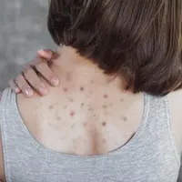 ilustrasi jerawat punggung/copyright shutterstock