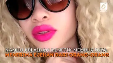 Namun kelainan genetik membuatnya menerima ejekan dari orang-orang.