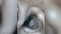 Detik-Detik Seekor Laba-Laba Merangkak Keluar dari dalam Telinga