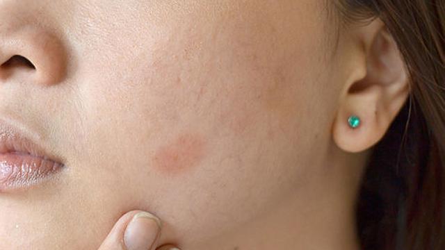 multi-sariawan-6-kulit-iritasi-1130912b.