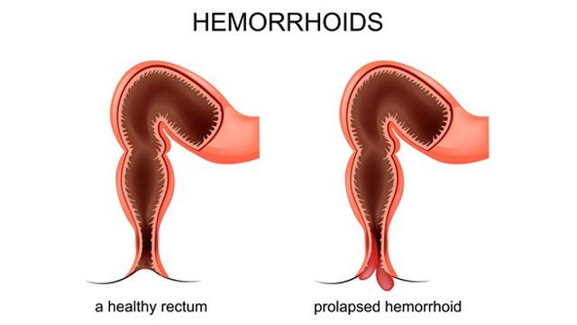 Hemoroid atau ambeien atau wasir