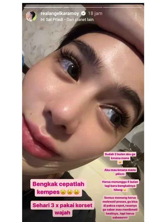 8 Potret Angel Karamoy Sebelum vs Setelah Operasi Plastik, Hasilnya Disebut Natural