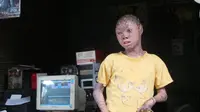 Ari Wibowo, remaja 16 tahun asal Tangerang yang memiliki kelainan kulit. (Liputan6.com/Benedikta Desideria)