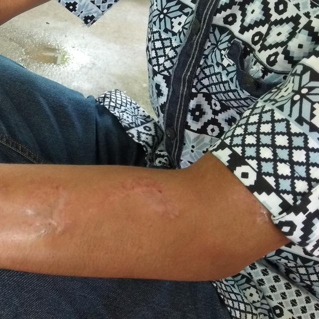 Kusta Terdeteksi Dini Pasien Bisa Sembuh Total Tanpa Cacat Health Liputan6 Com