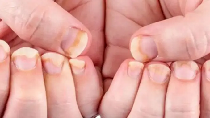 Gejala Awal Kuku Berjamur yang Harus Diwaspadai