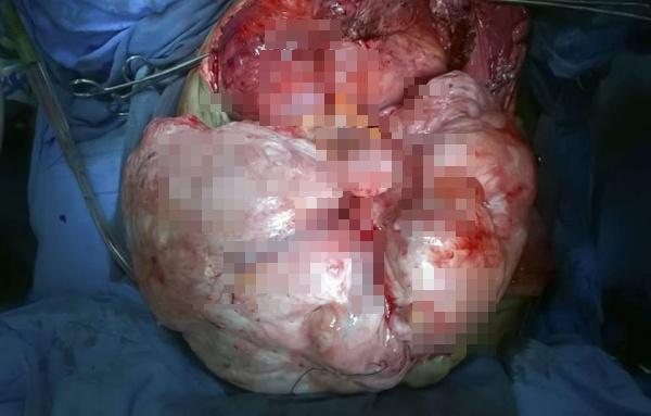 Tumor yang berhasil diangkat dari tubuh Devi | Photo: Copyright metro.co.uk
