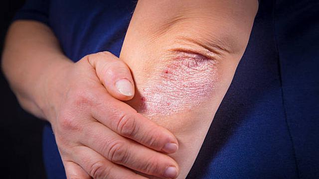  Gambar  Penyakit Kulit  Psoriasis Berdasarkan Jenis Kenali 