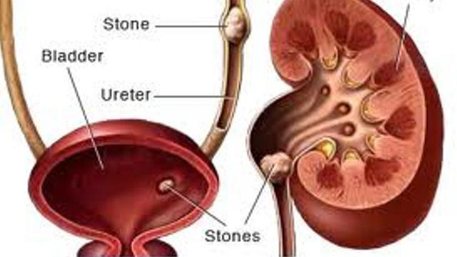 [Bintang] Mengenal Batu Ginjal, Sang Penyumbat Saluran Kemih