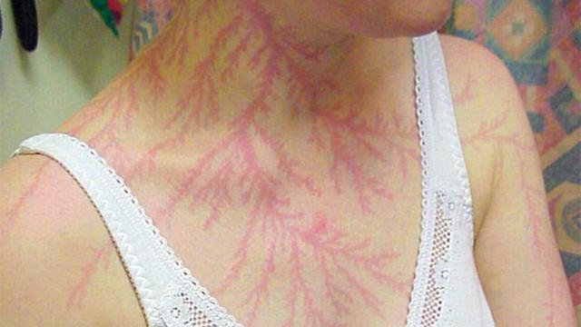 Bekas luka sambaran petir (foto: boredpanda)