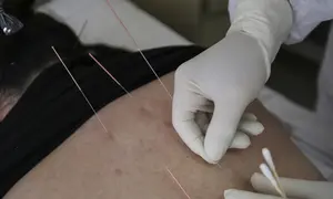 Pasien terinfeksi virus corona COVID-19 menerima perawatan akupunktur di Rumah Sakit Palang Merah di Wuhan, China (11/3/2020). Peningkatan kasus virus corona di China memicu kekhawatiran bahwa infeksi dari luar negeri dapat merusak kemajuan dalam menghentikan penyebaran virus tersebut. (AFP/STR)