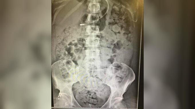 Hasil rontgen menunjukkan bahwa kotoran telah menyebar hingga bagian dada Kelly Yeoman (Facebook/Kelly.yeoman.7)