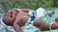 Bayi berkepala dua meninggal di Rumah Sakit Ibnu Sina, Gresik, Jawa Timur. (Liputan6.com/Dhimas Prasaja)