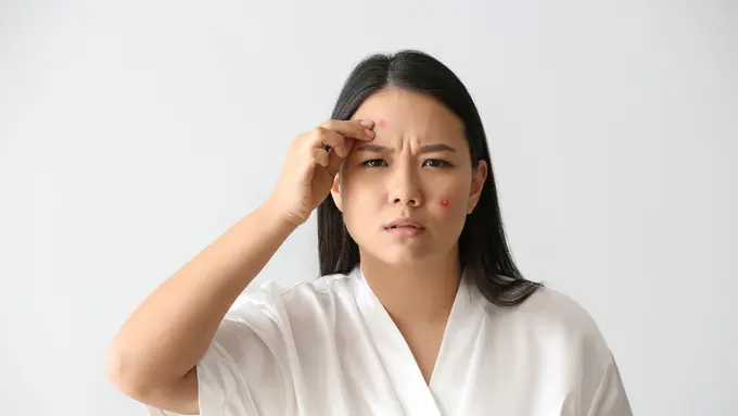 Jerawat pada Ibu Hamil, Awas Penanganan Kurang Tepat! Intip Penyebab dan Cara Aman Mengatasinya