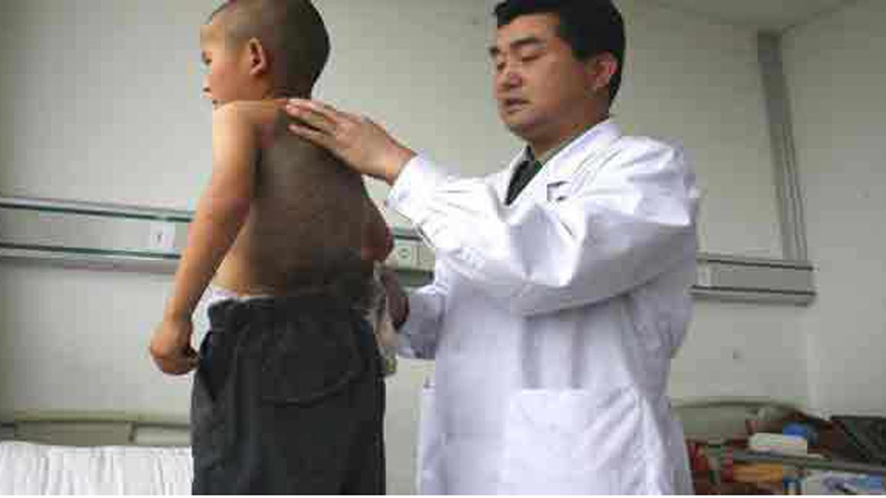 5 Tanda Lahir Teraneh di Dunia