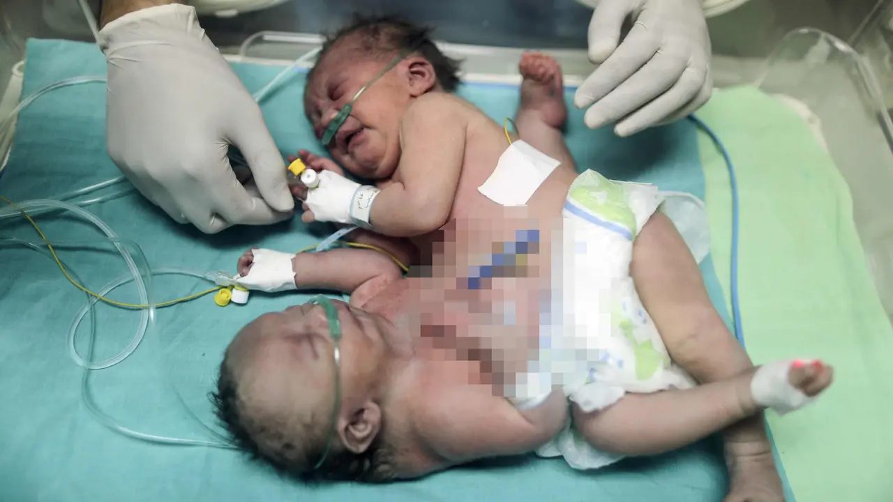 Bayi Kembar Siam