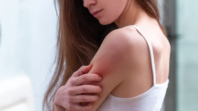 Ilustrasi psoriasis