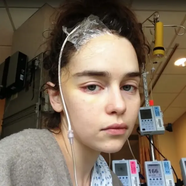 Emilia Clarke saat melakukan perawatan aneurisma otak