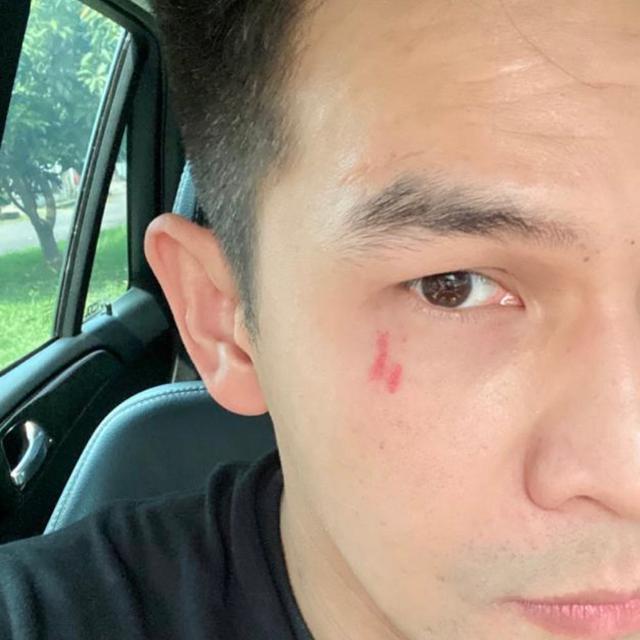 Foto Jonathan Frizzy dengan bekas luka cakar yang diunggah Benny Simanjuntak (https://www.instagram.com/p/CUC3kajpDT1/)