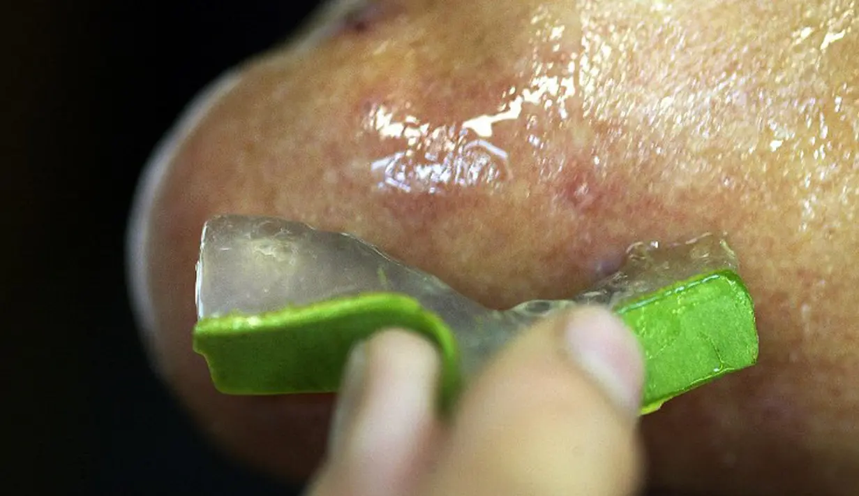 Ambil gel yang terdapat di lidah buaya lalu oleskan pada area hidung yang terdapat komedo dan diamkan sekitar 10 menit. Kemudian bersihkan wajah dengan air hingga benar-benar bersih. (AFP PHOTO/Peter PARKS)