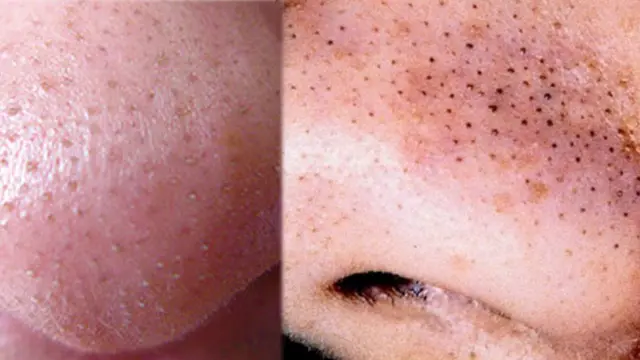 [Bintang] Gara-gara Kebiasaan Pencet Komedo, Gadis Ini Jalani Operasi Otak