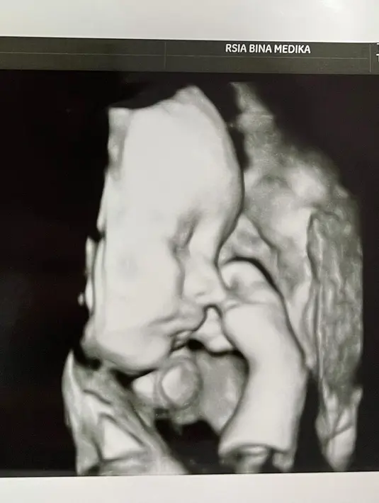 Hingga berita ini dituliskan, bayi mungil itu masih dalam perawatan di ruang NICU. Namun Audy bersyukur lantaran kondisi anaknya dalam keadaan yang baik. (Instagram/audymarissa)