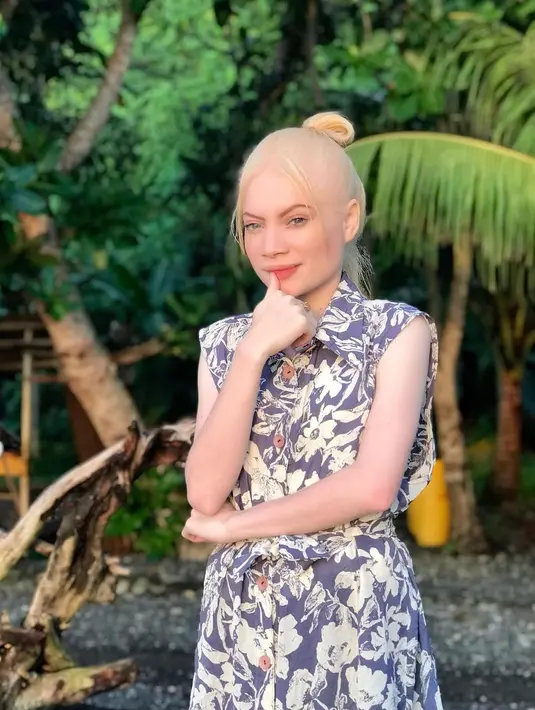 Albino yang diidapnya membuat Herolena memiliki kulit putih, disebut-sebut seperti barbie.