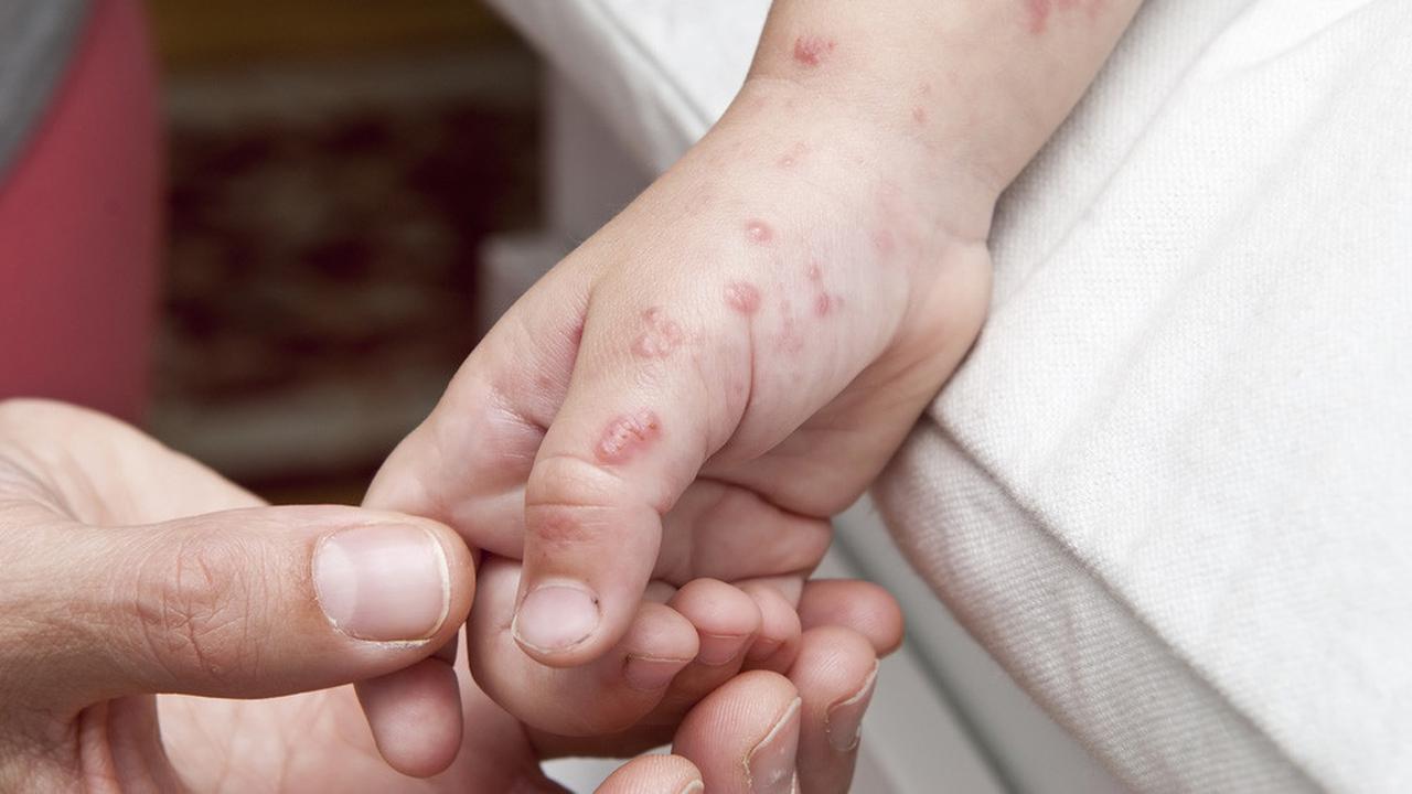 Herpes Zoster atau Cacar Api, Kenali Penyebab dan Cara Mengatasinya