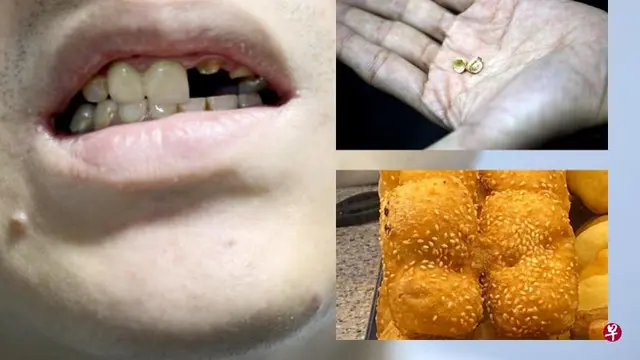 Tak Sengaja Makan Batu Dalam Roti, Dua Gigi Pria Ini Patah