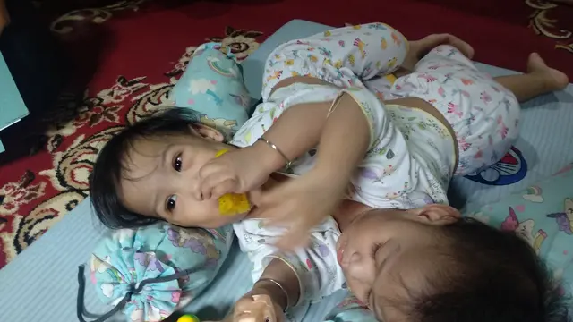 Bayi kembar siam Kendari, Aqila Dewi Sabila dan Azila Dewi Sabrina, sebelum dipisahkan.(Liputan6.com/Ahmad Akbar Fua).