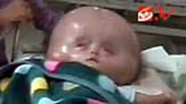 RSCM Telantarkan Bocah Penderita Hydrocephalus