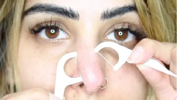 Unik, Cara Baru Bersihkan Komedo dengan Bantuan Benang Gigi