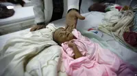 Anak malnutrisi di Yaman. (AP)