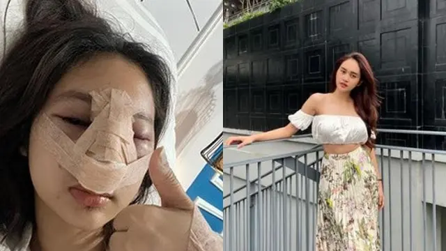 Beda Penampilan 5 Seleb Wanita Tanah Air Jalani Operasi Plastik saat Diperban Vs Setelahnya
