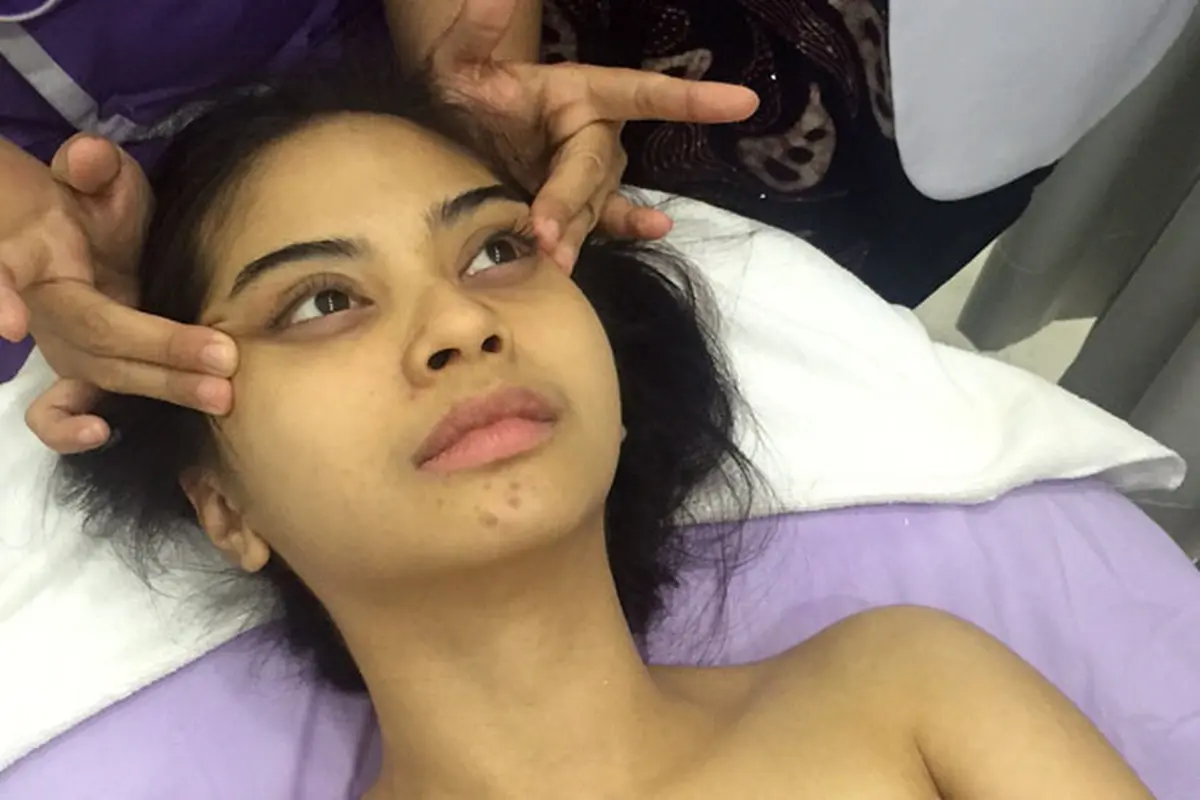 Pakai Obat Kulit Abal-abal, Begini Wajah Tiwi eks T2