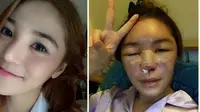 Gara-gara Suntik Silikon, Model ini Berubah Jadi Buruk Rupa