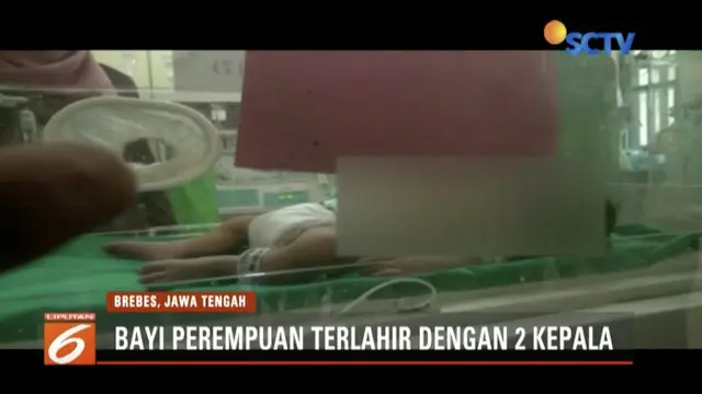 Seorang ibu di Brebes, Jawa Tengah, melahirkan bayi perempuan berkepala dua. Ia dan suami berharap pemerintah dapat membari bantuan.
