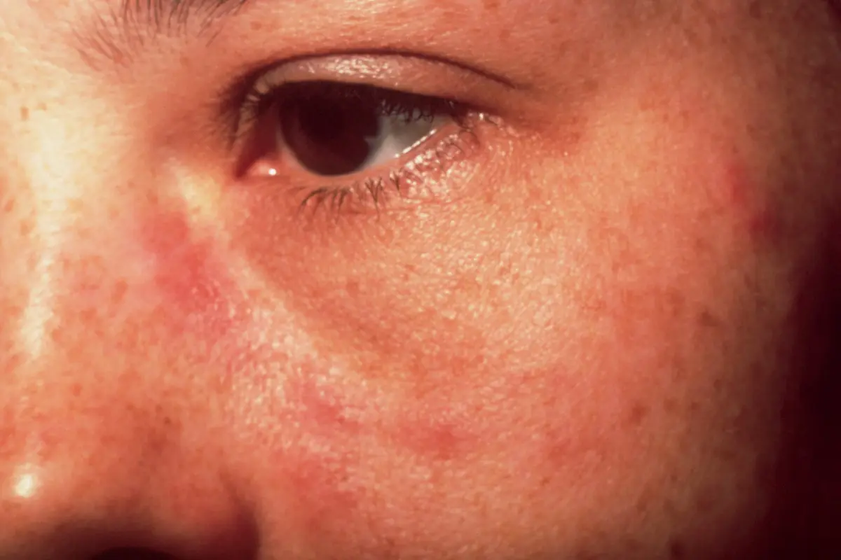Ini Gejala Awal Penyakit Lupus yang Harus Diwaspadai. (Foto: Shminhe)