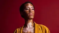 Akibat vitiligo, Amy Deanna memiliki warna kulit berbeda dari orang kebanyakan, tapi itu pulalah yang membuat ia sukses jadi seorang model. (Foto: Instagram/@amy.deanna)