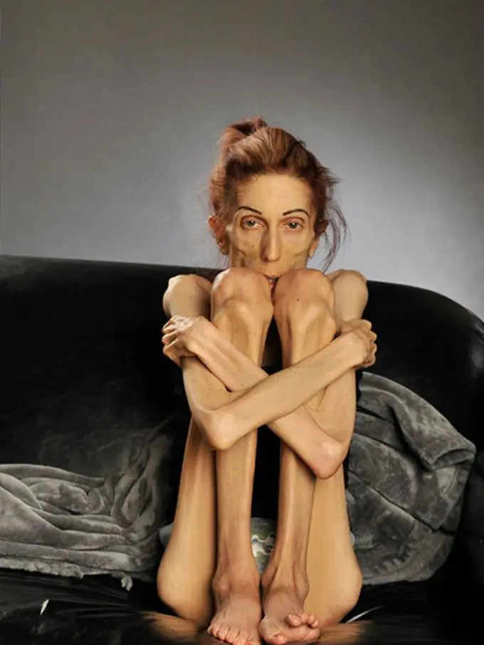 Rachael Farrokh, Penderita Anorexia yang Sekarat dan Ingin Insyaf