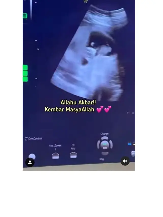 Hamil Anak Kembar, Ini 11 Potret Anisa Rahma dan Anandito Jalani Bayi Tabung