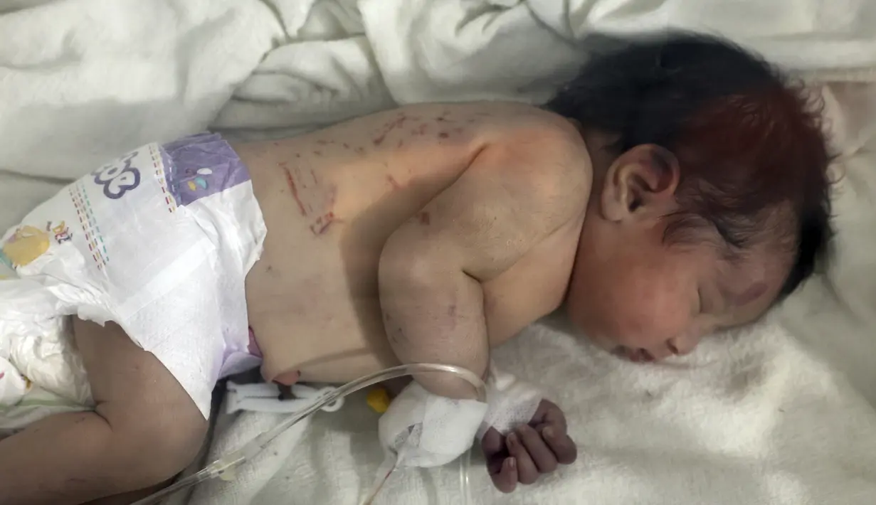 Seorang bayi perempuan yang lahir di bawah reruntuhan akibat gempa bumi yang melanda Suriah dan Turki menerima perawatan di dalam inkubator di rumah sakit anak di kota Afrin, provinsi Aleppo, Suriah, Selasa (7/2/2023). Di dalam inkubator di rumah sakit di Afrin, bayi yang baru lahir tersebut dihubungkan ke infus, tubuhnya terluka, dan perban melilit tangan kirinya. (AP Photo/Ghaith Alsayed)