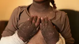 Doaa menunjukan kulit tangannya yang berubah akibat dampak bom kimia di Qayyara, Irak, (12/11). Pabrik kimia yang dibakar oleh ISIS selain memakan korban jiwa, anak-anak mengalami cacat pada kulit tubuh akibat radiasi asap. (REUTERS/Air Jalal)