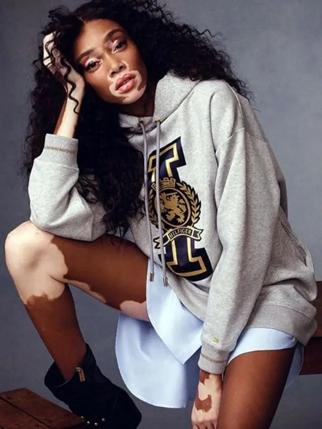 [Fimela] Perjalanan Panjang Winnie Harlow Sebelum Jadi Model Victoria’s Secret